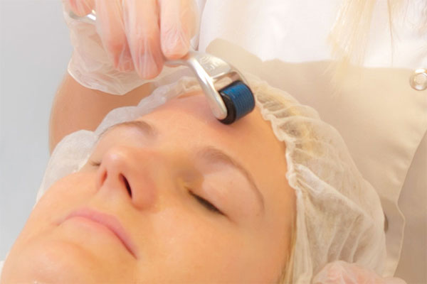 Eine Mesotherapie Behandlung mittels Mesoroller auf der Stirn